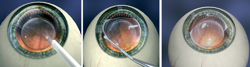 Cirugía Refractiva - Instituto Gallego de Cirugía Ocular en Ferrol